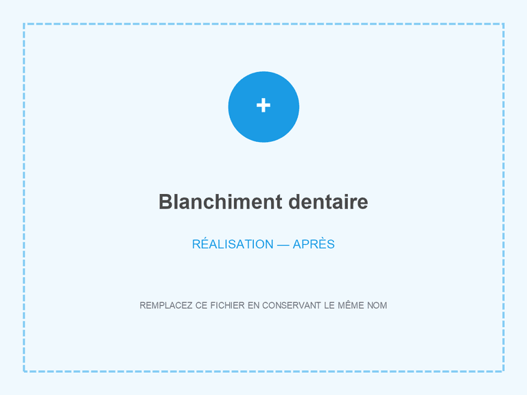 Résultat après blanchiment dentaire