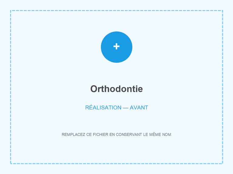 Alignement dentaire avant traitement orthodontique