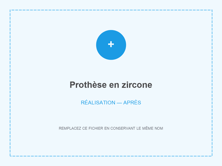 Résultat après pose d’une prothèse en zircone